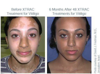 XTRAC Vitiligo Patients Treatment