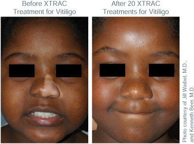 XTRAC Vitiligo child treatment