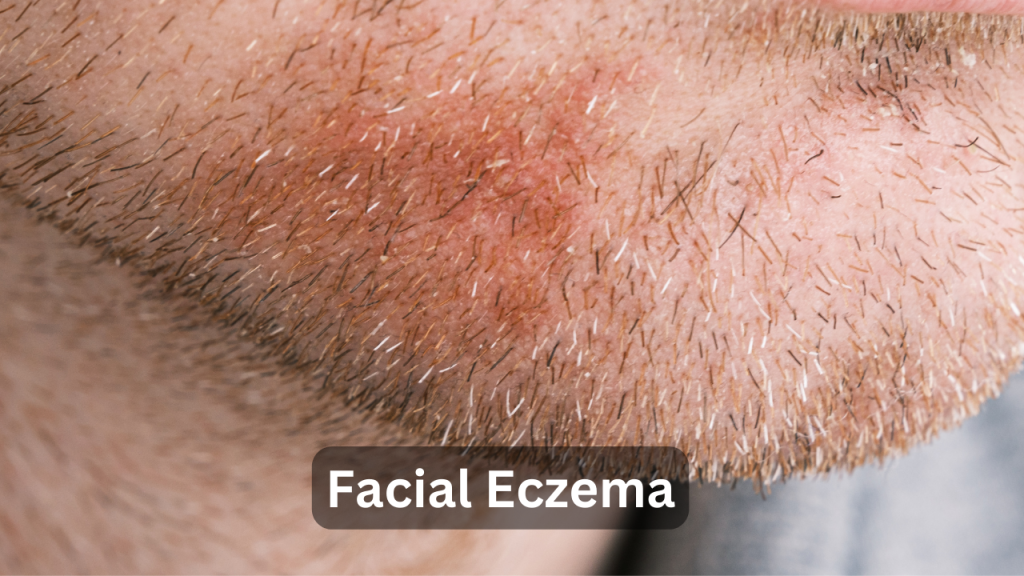 Facial Eczema