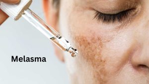 Melasma treatment at Lucid