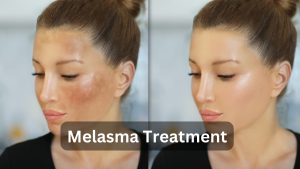melasma treatment before and after