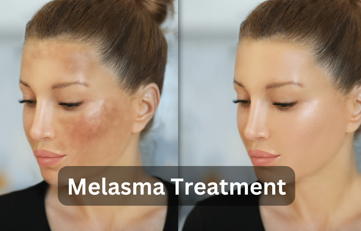 can glutathione treat melasma How Dermatologists Melasma: A Step-by-Step Guide Winter Radiance Combo: Glutathione Color:5CC Intense light Ash Brown كريم نومبوزين رقم 5+ 50 مل