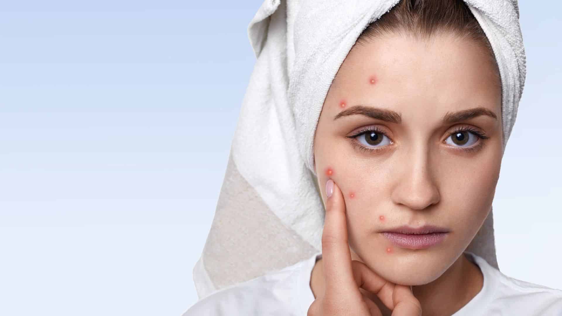 Acne treatment