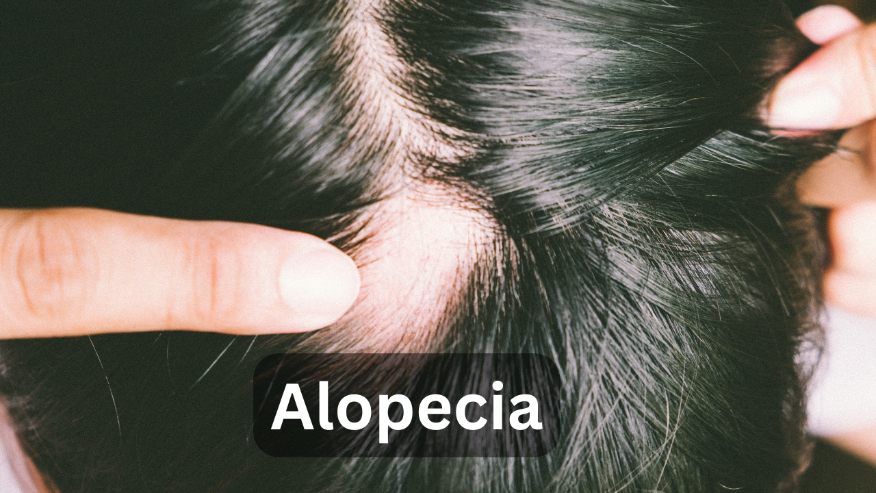 A patient get treatment of Alopecia.