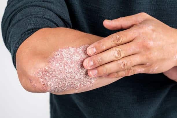 Biologics for Psoriasis: Are They Right for You?