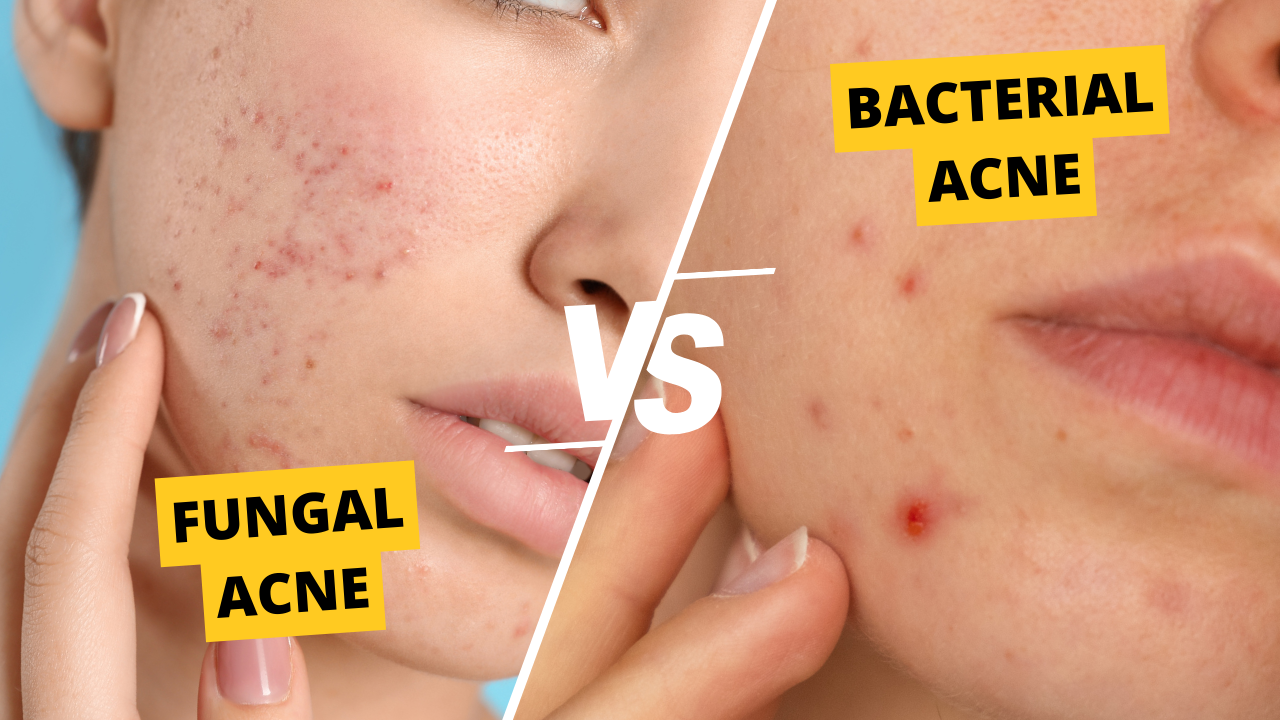 Acne treatments