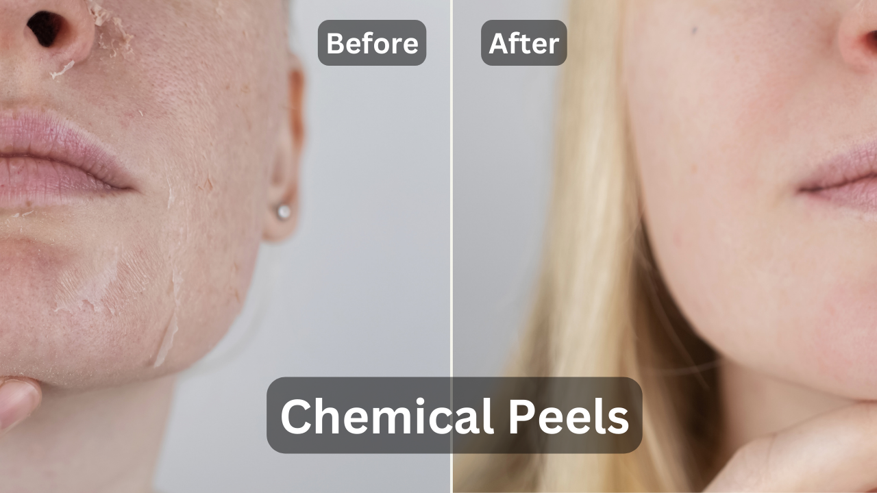A women showing her face before and after chemical peels treatment