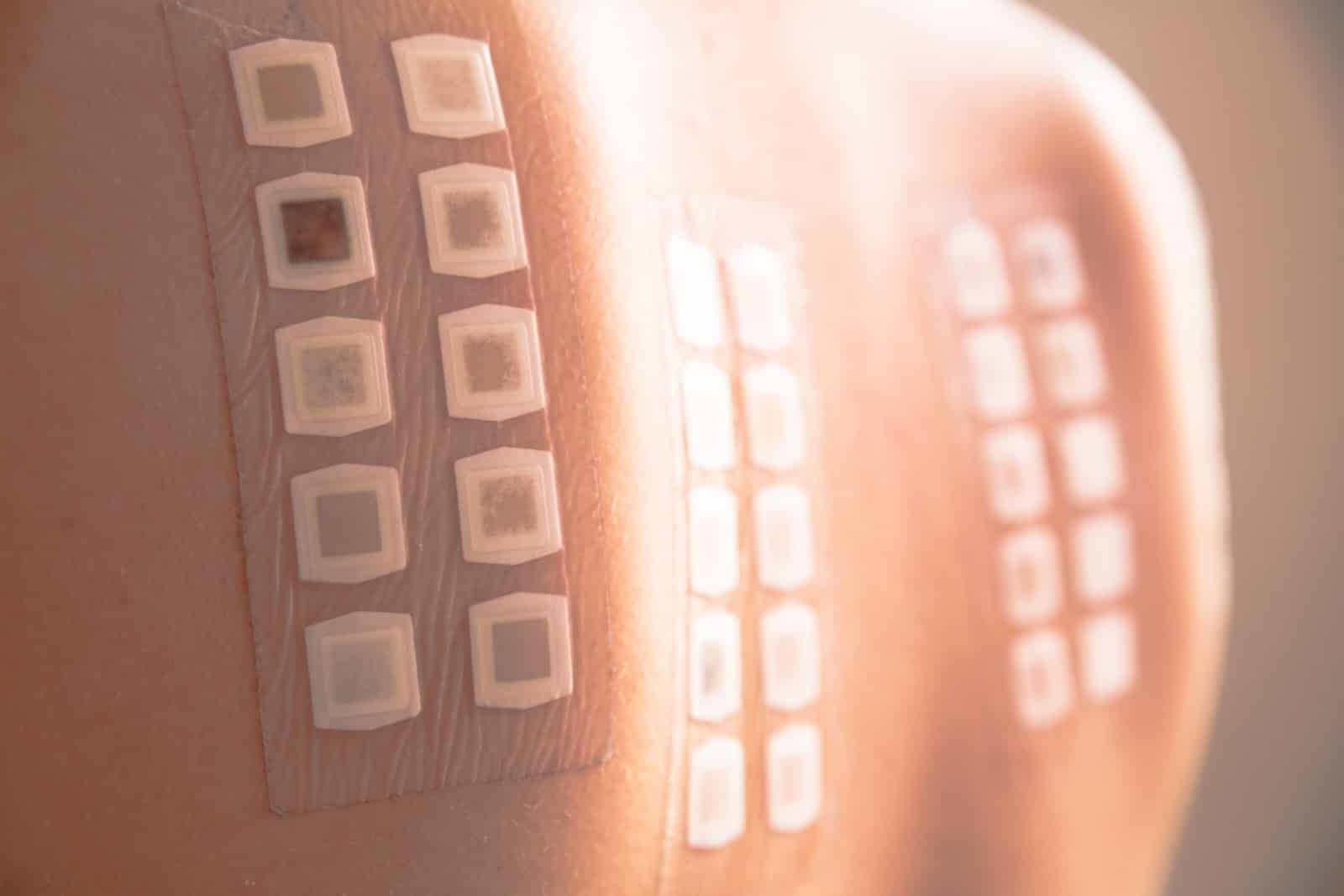 Chronic Rash Treatment 101: Allergy Patch Testing