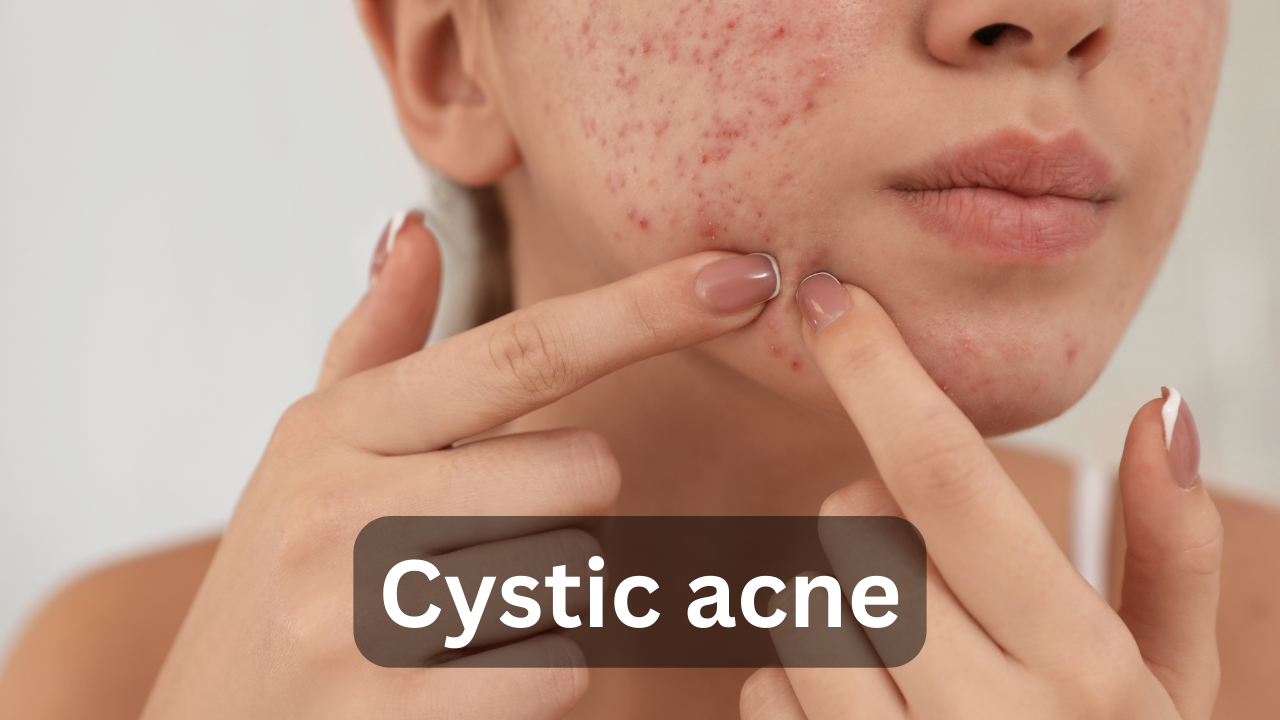 A women shows cystic acne on her face