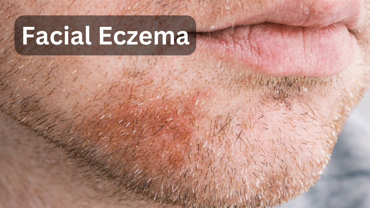 A person have Eczema on his face