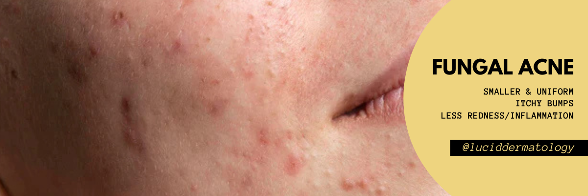 Fungal Acne vs Bacterial Acne: Why Self-Diagnosis Can Make It Worse