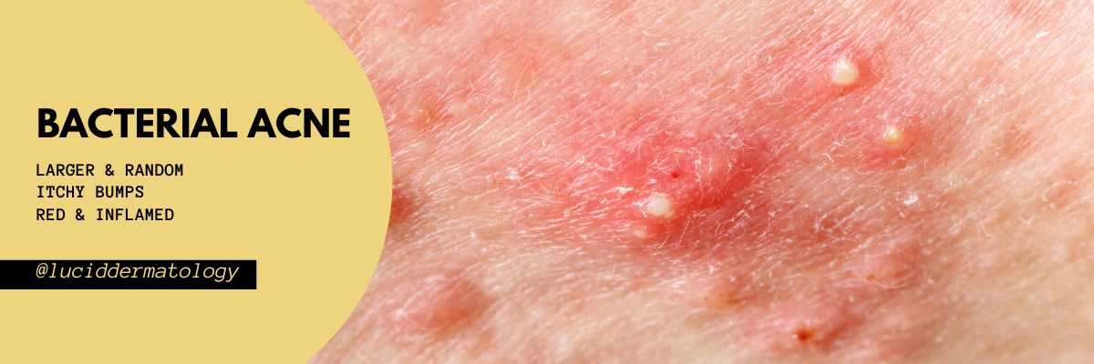 Fungal Acne vs Bacterial Acne: Why Self-Diagnosis Can Make It Worse