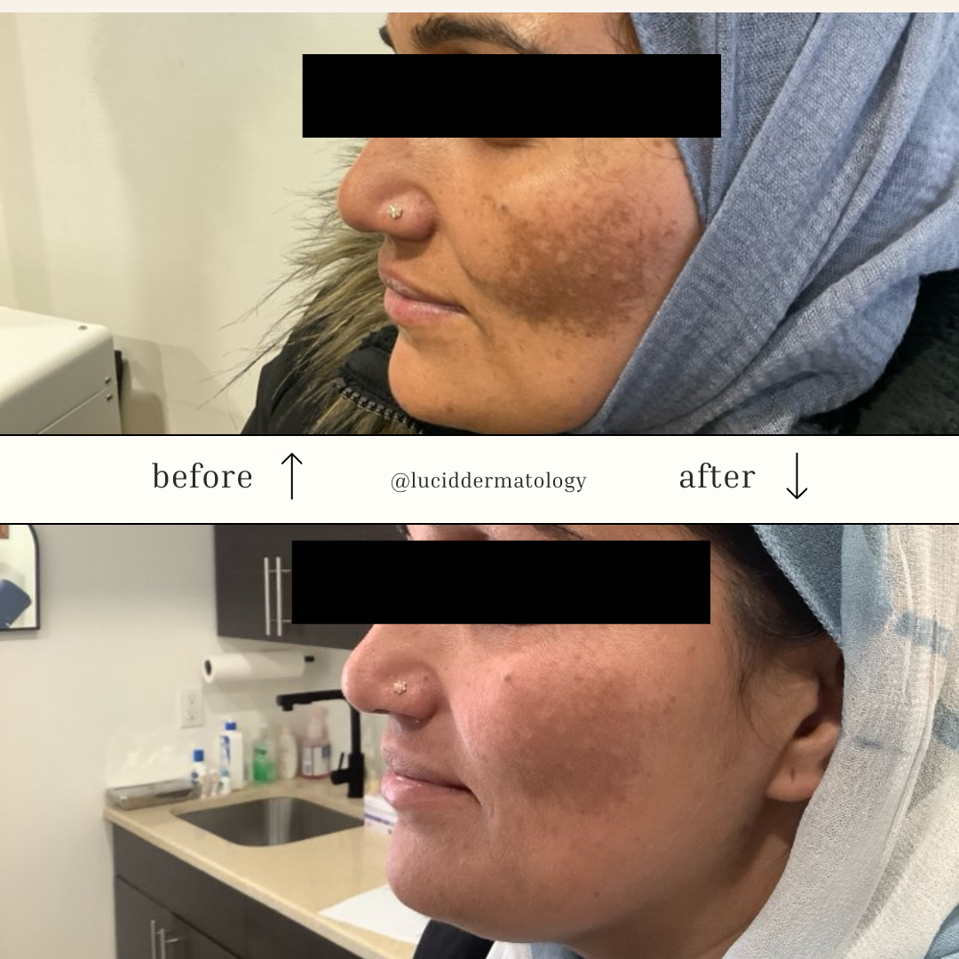 Before and After images of melasma