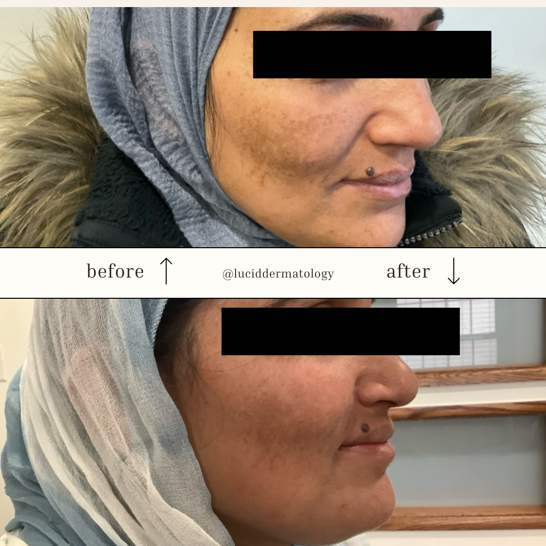 Before and After melasma treatment