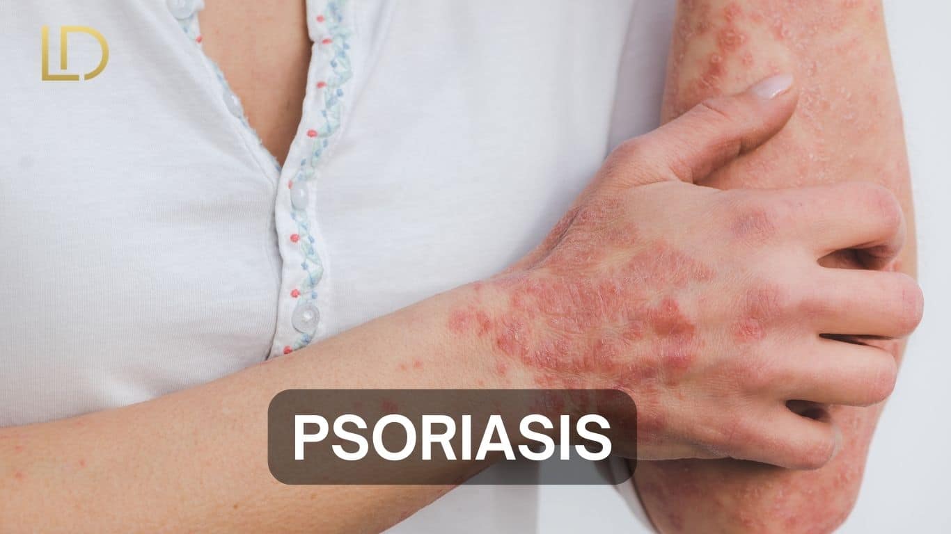 A women have Psoriasis in her hand and find treatment.