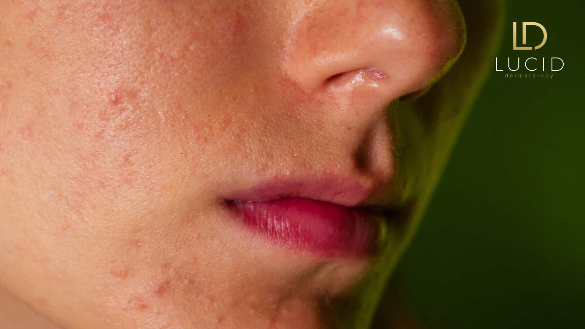 Sebaceous Glands Lead to Oily Skin and Acne