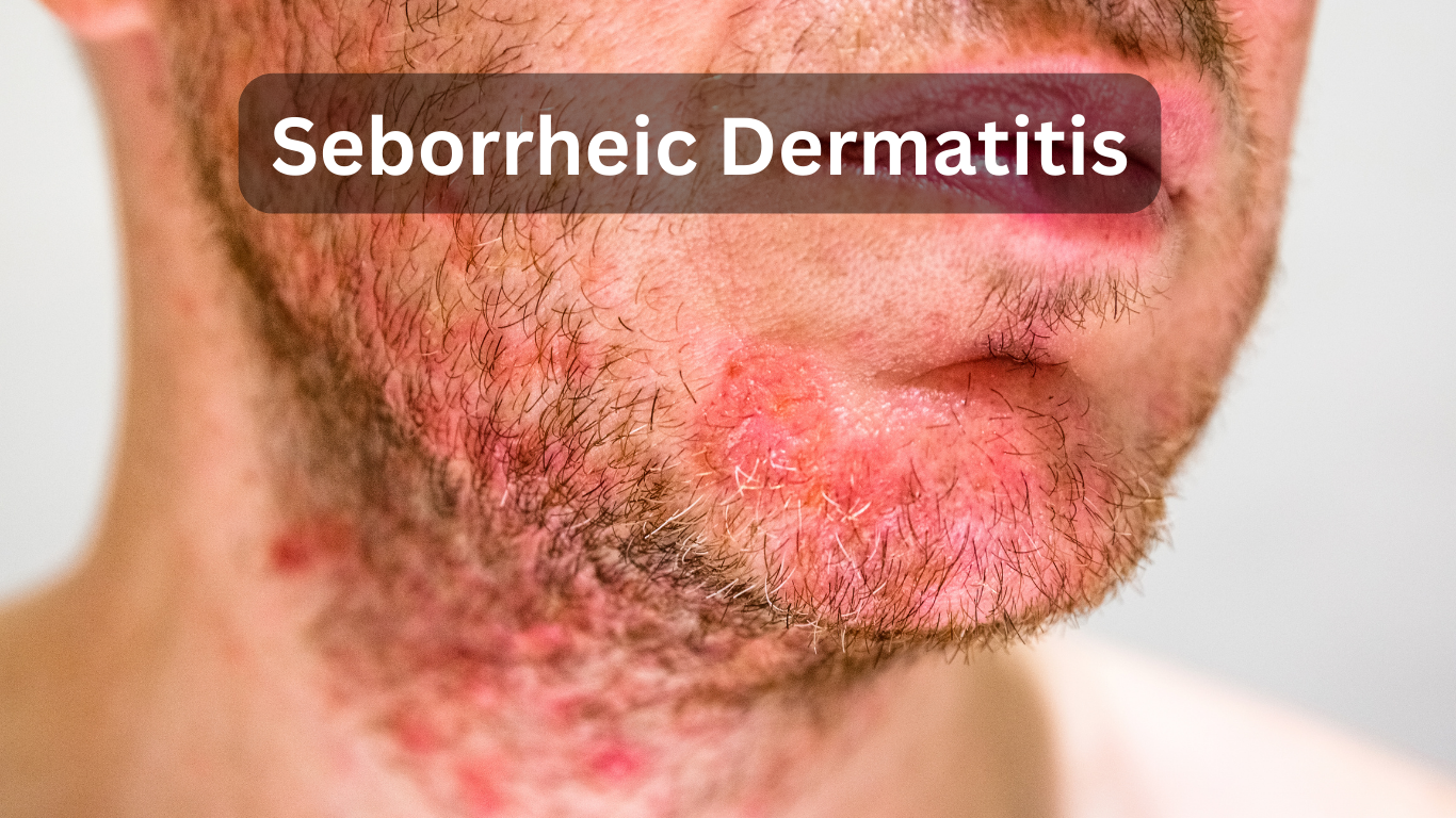 A man taking Seborrheic Dermatitis treatment