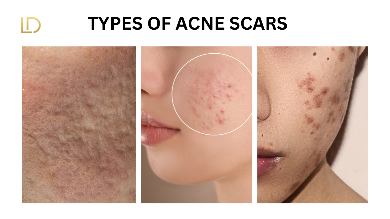 patients showing her acne scars