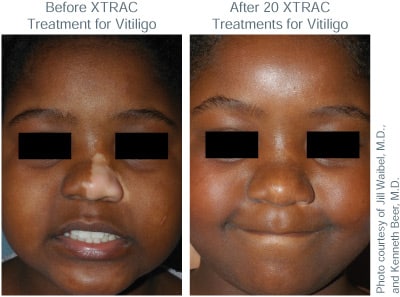 XTRAC Vitiligo child treatment