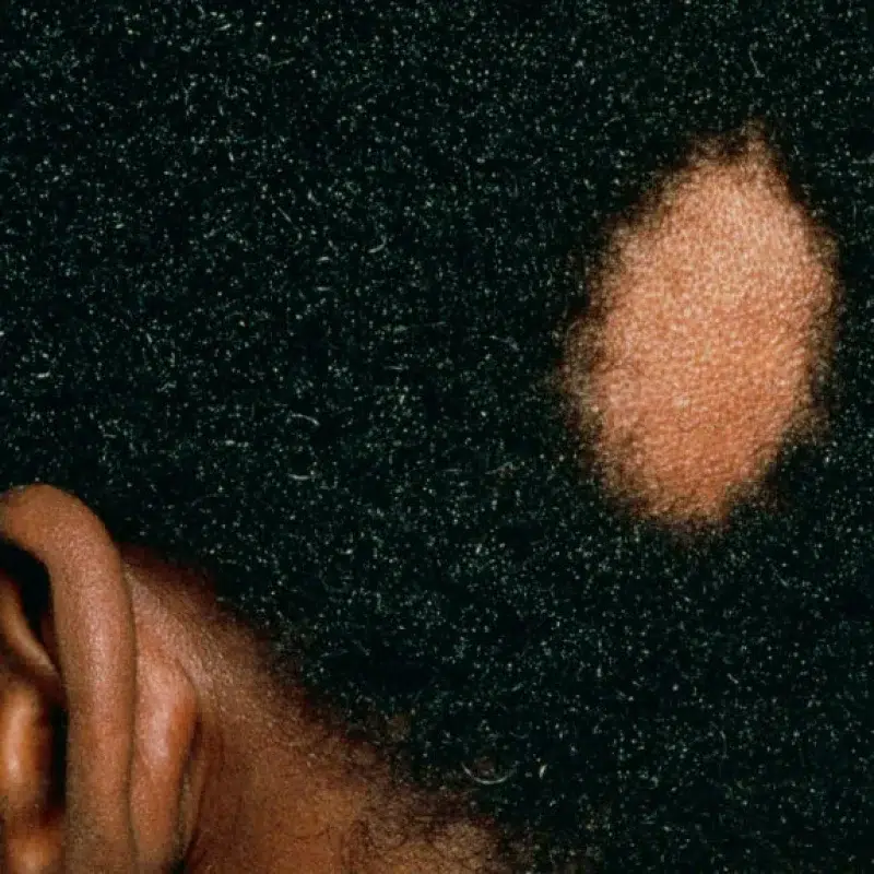 Lucid Dermatology - Hair Loss - African American 2