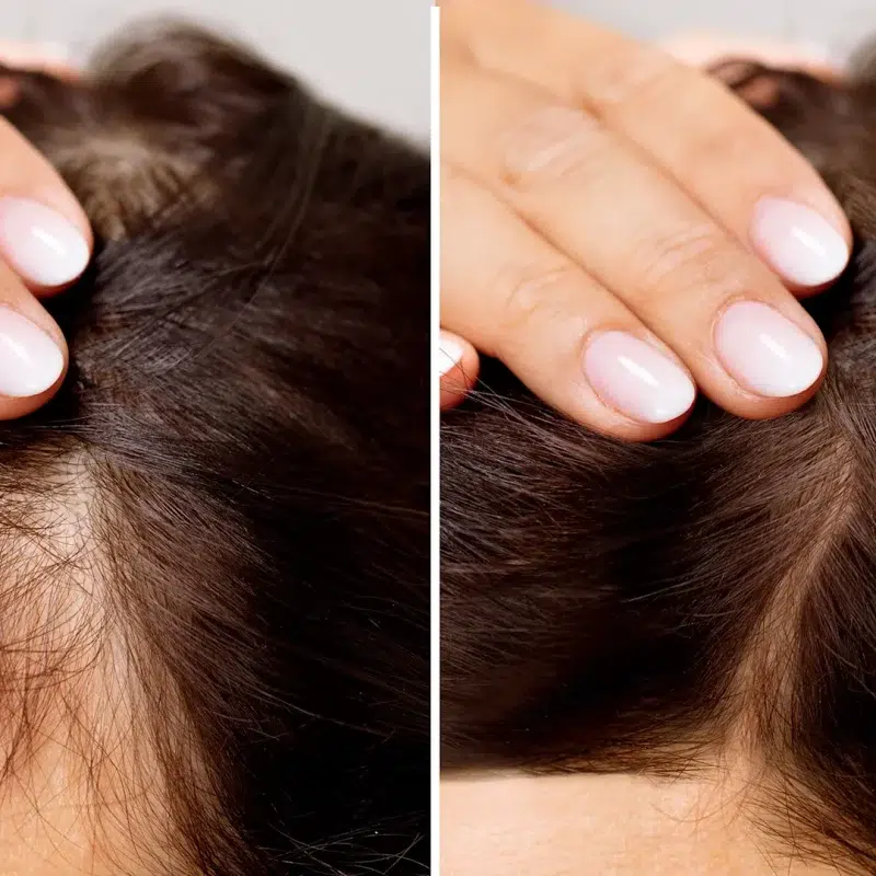 Hair Loss Medication Before and After