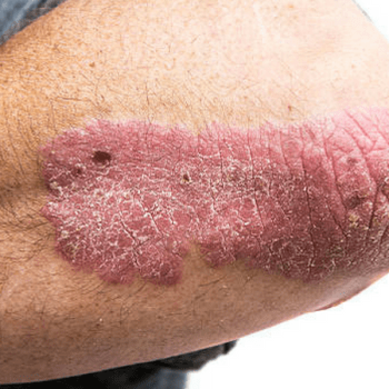 Psoriarsis