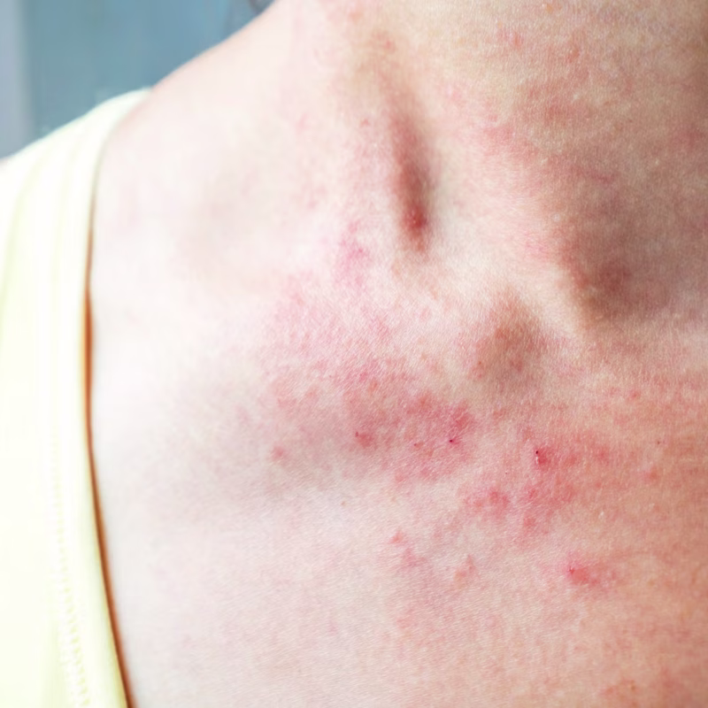 Inflammed Rashes