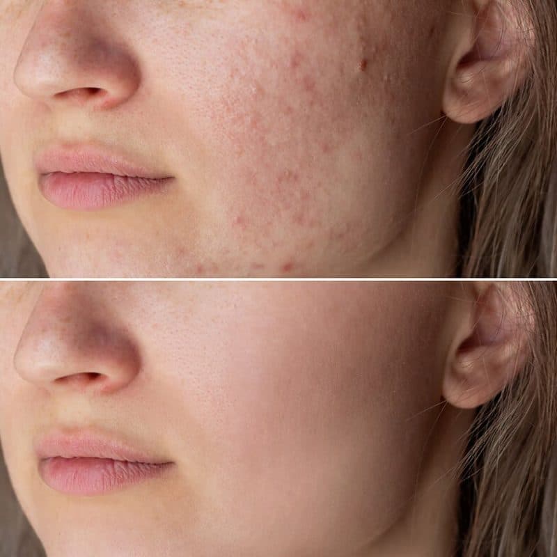 Rash Before and After