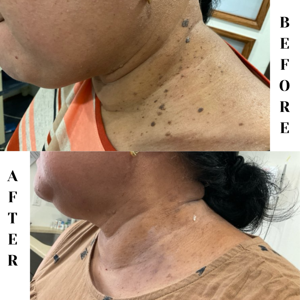Before and After Image: Case 3 - left-side