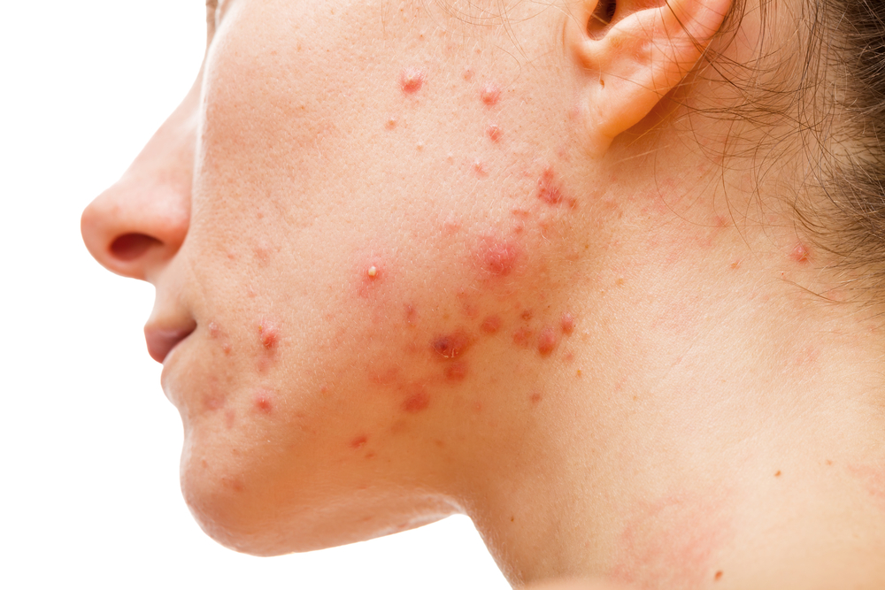 Close-up image of hormonal acne of a woman's jaw