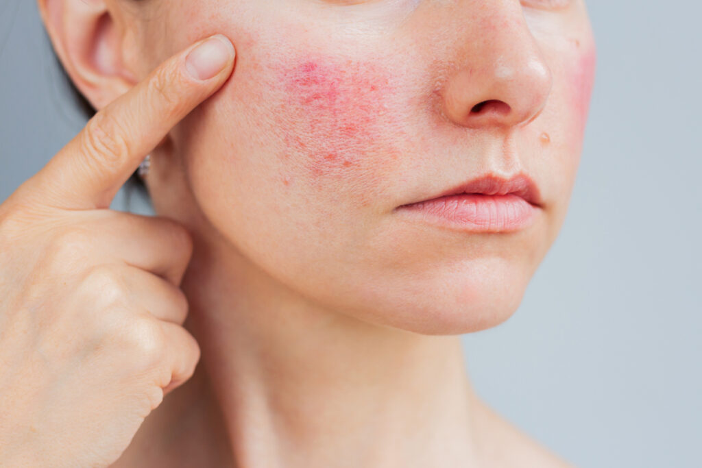Close-up shot of rosacea on a woman's cheek