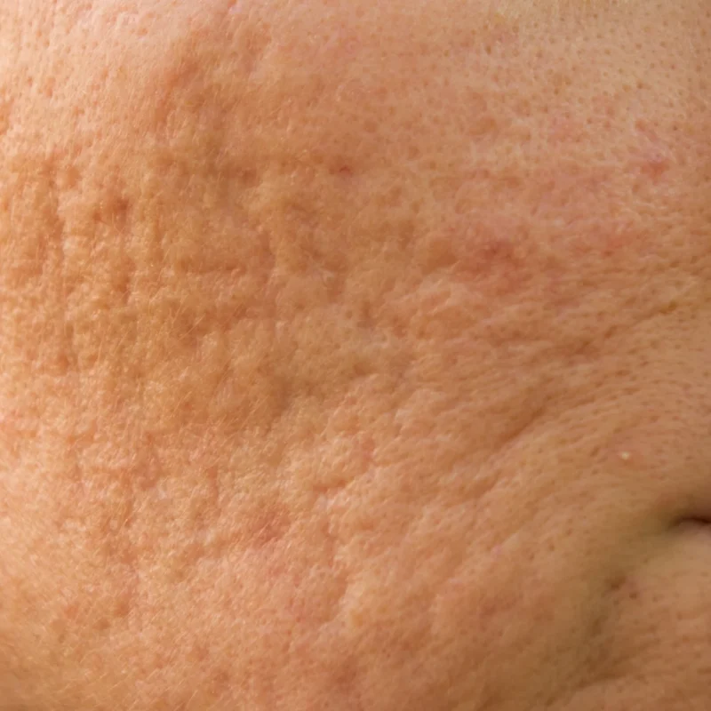 Acne Scarring