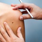 Complete Skin Exam