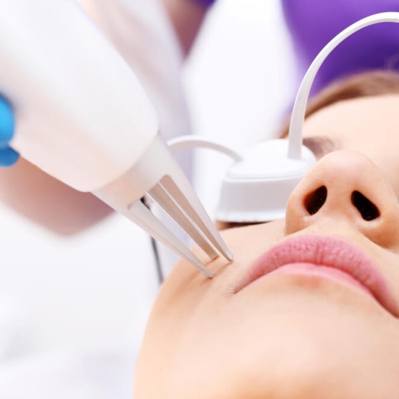 Lucid Dermatology - Acne Laser Treatment
