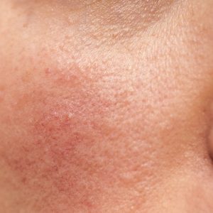 Lucid_Dermatology_Rosacea_Treatment