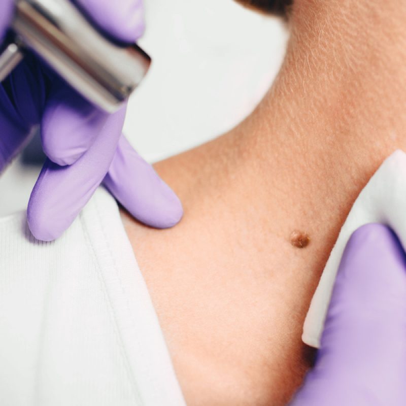 removing a large mole on a patient s neck with a medical laser. Laser removal of mole