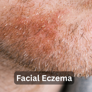 Facial Eczema