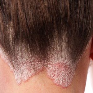 psoriasis-scalp-722x406